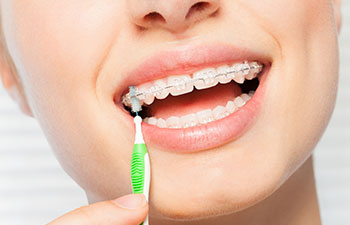 Cleaning braces with proxa brush.