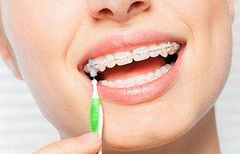Cleaning braces with proxa brush.
