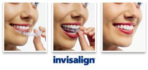 Marietta GA Invisalign Invisible Adult Braces