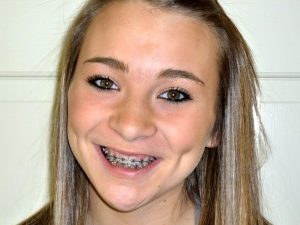 Smiling teenage girl with metal orthodontic braces.